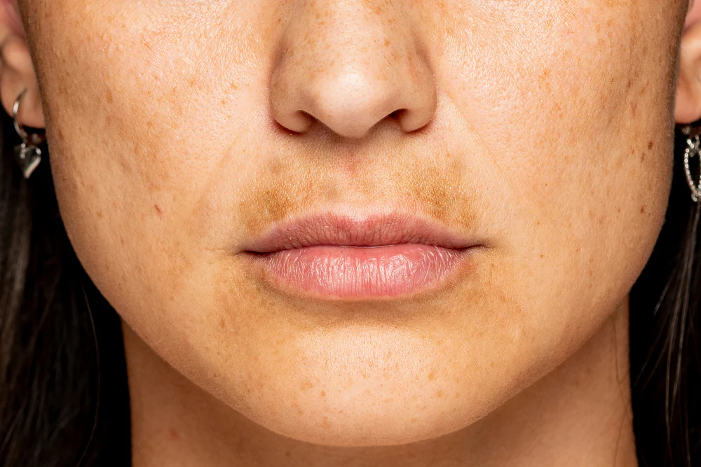 Avoiding Hyperpigmentation and Uneven Skin Tone