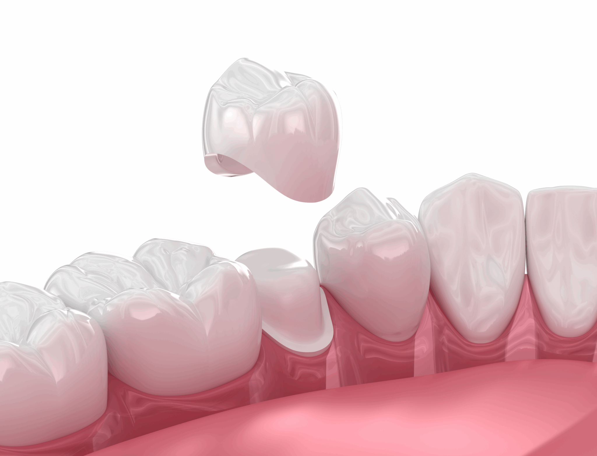 Dental Crowns